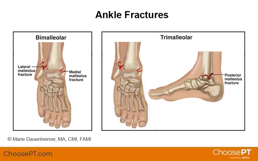 Illustration of Ankle Fractures