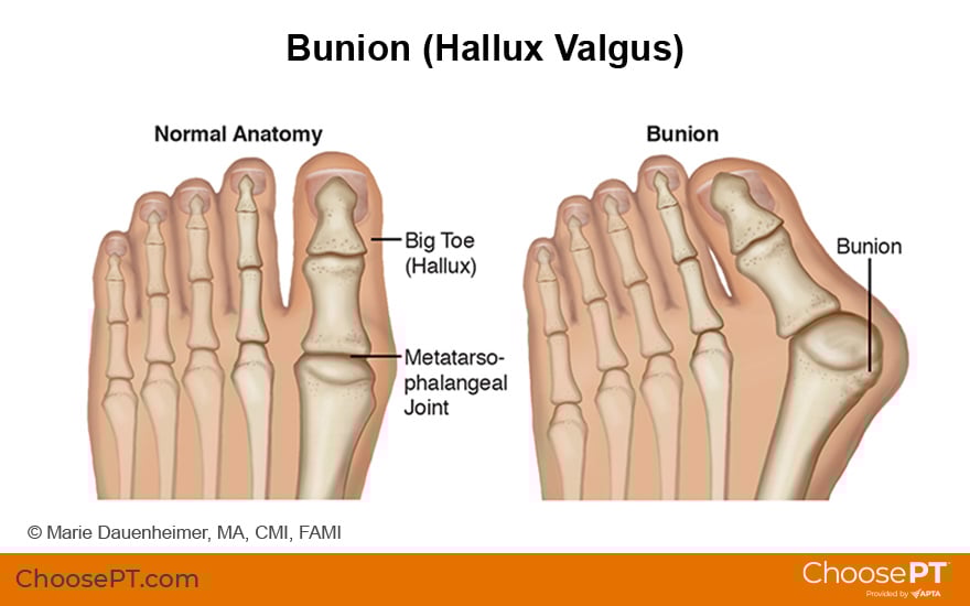 Illustration of Bunion (Hallux Valgus)