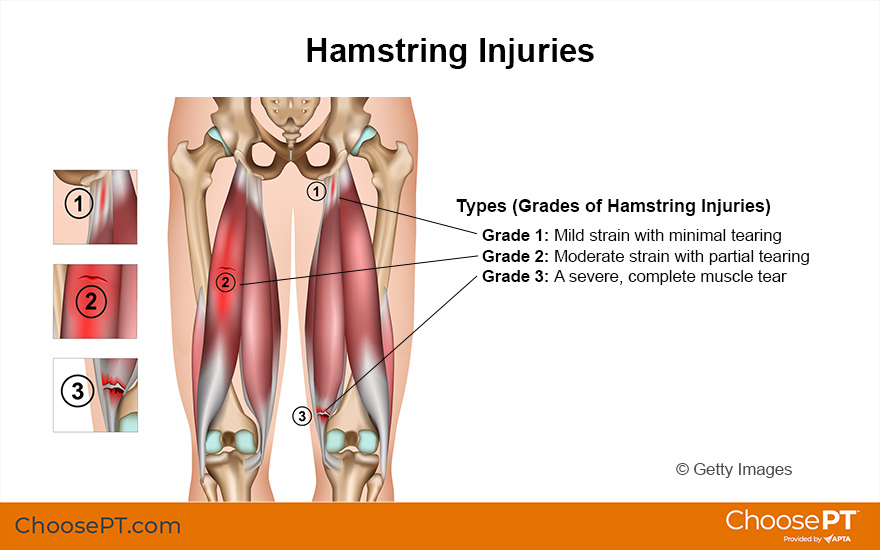 Illustration for Hamstring Injuries