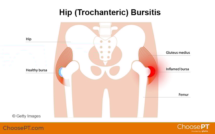Illustration of hip bursitis