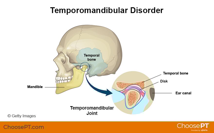 Illustration of temporomandibular disorder of the jaw