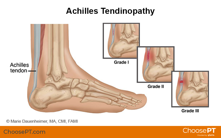 Illustration of achilles tendinopathy
