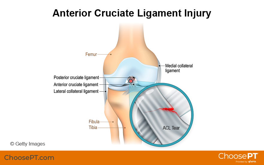 Illustration of Anterior Cruciate Ligament Injury