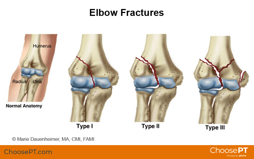 Illustration of elbow fractures